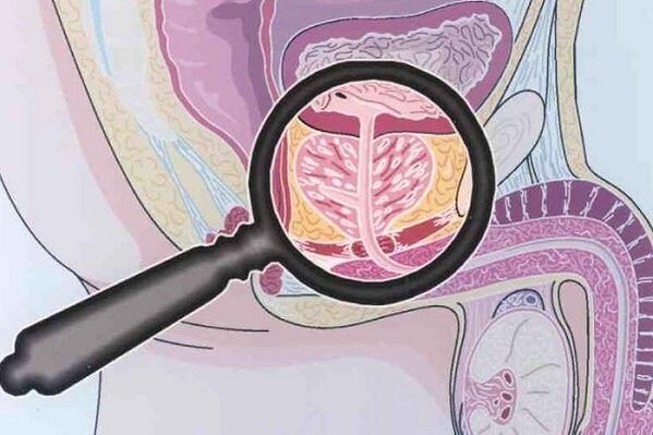 Prostatitis disease