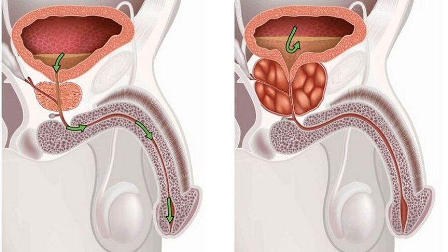 Prostatitis in men